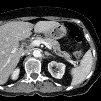 Conventional CT shows very subtle lesion in pancreas, not prospectively call-able