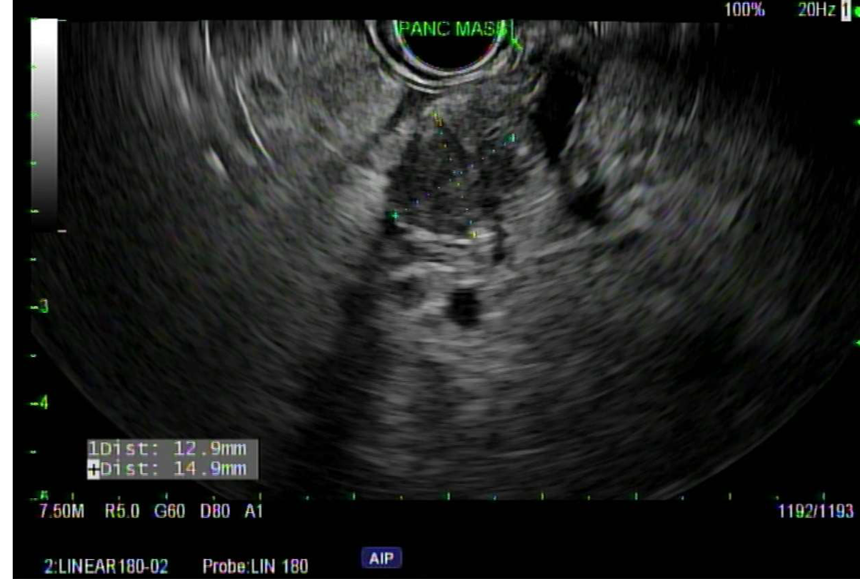 Mass biopsied on endocspoic ultrasound