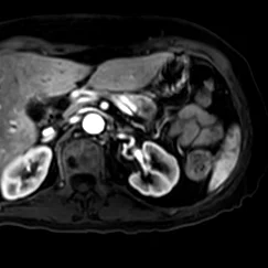 Contrast enhanced MR shows hypoenhancing pancreatic lesion 