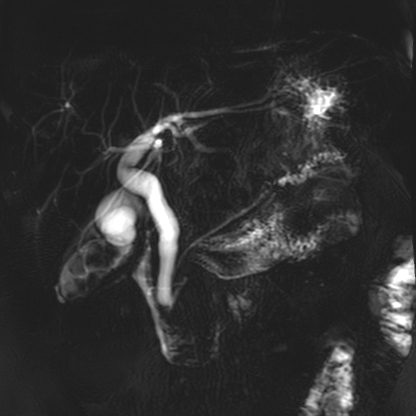 MRCP with focal ductal dilatation in the pancreatic tail shown very nicely