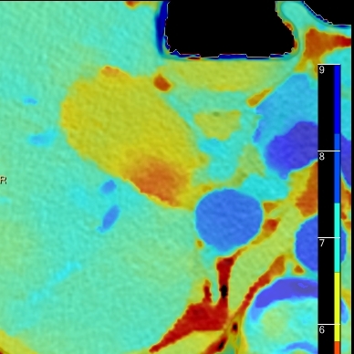 Gallstones easily seen on effective atomic number overlay image
