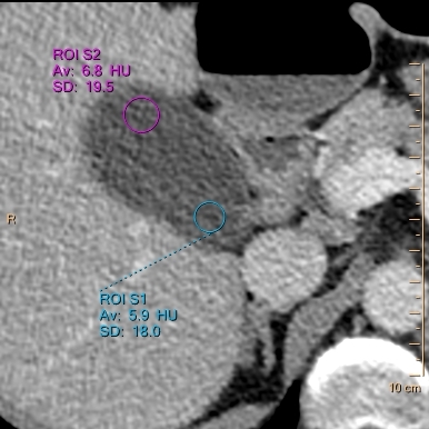 On conventional image, attenuation of bile (magenta ROI) and gallstones (blue ROI) is nearly the same. No wonder they are invisible.