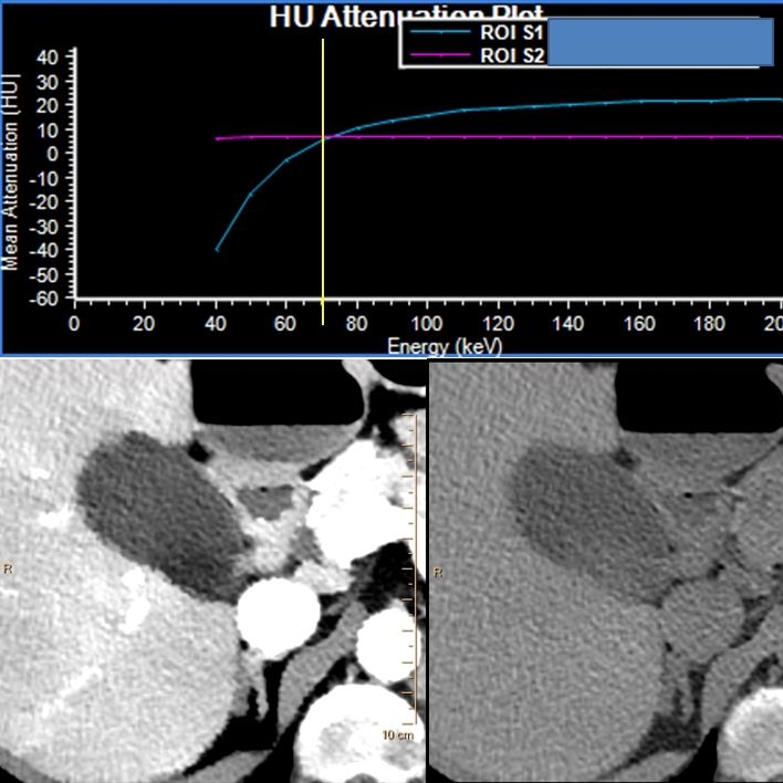 Spectral plot is very enlightening: at 70 kev (yellow line) , attenuation curves of bile and gallstones intersect, so they cannot be seen. At 40 keV (left), stones are hypodense relative to bile, and at 200keV (right), they are hypredense. This is obvious on the respective images.
