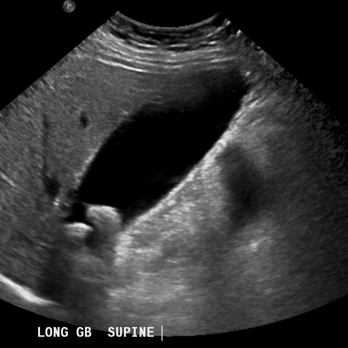 Ultrasound confirms gallstones, but no sign of acute cholecystitis