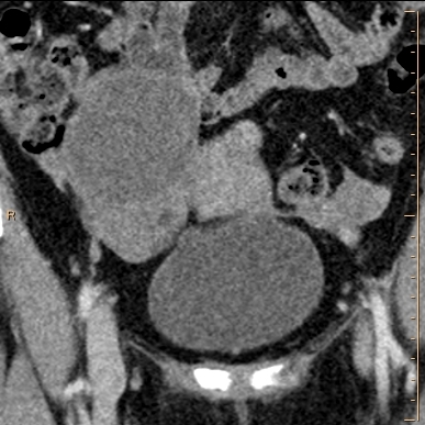 Conventional coronal CT through pelvis shows right ovarian cyst, otherwise unrerkanle