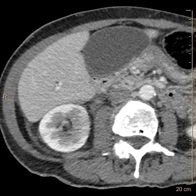Conventional CT shows subtle hypoperfusion in the right kidney medially. Note the gallbladder looks normal.