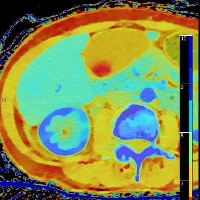 Overlay Z-effective image shows the renal cortical defect very well, but note a gallstone now pops into view!