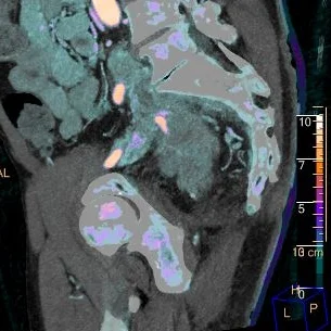 Oblique sagittal with iodine overlay nicely demonstrates the intravenous extension.
