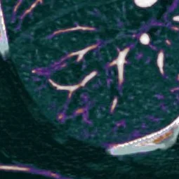 "Tree-in-bud" can mean tumor in bronchi too...