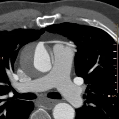 Conventional CT through ascending aorta. Note dissection flap on the left side of the aorta, and the saphenous venous graft anteriorly. The low-density crescent on the right side of the aorta is why we do non-contrast scans: it can be hard to tell intramural hematoma/thrombosed lumen versus plaque once you have given contrast