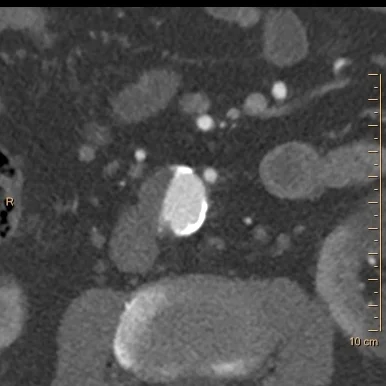 Mural irregularity at the level of the IMA in the abdominal aorta, this could be plaque or intramural hematoma.