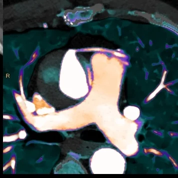 Do we really need a true non-contrast scan for aortic imaging?