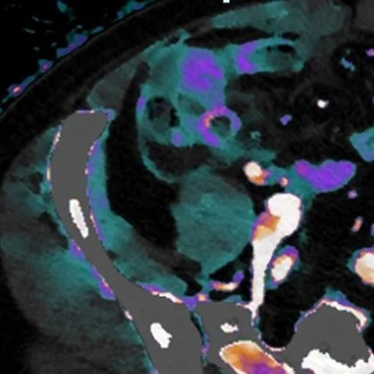 The hot appendix: part 2