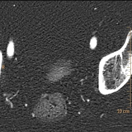Iodine map with intense uptake in the urinary bladder "filling defect", consistent with tumor