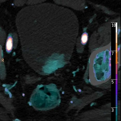 Perfusion nicely depicted on iodine overlay