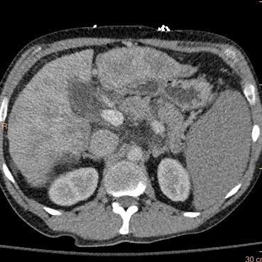 Conventional CT shows cirrhosis with varices. The spleen does not stand out as particularly abnormal.