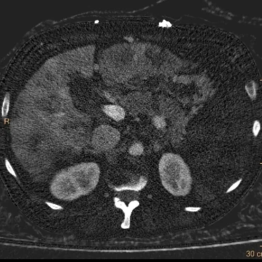 Iodine map: The spleen is gone!