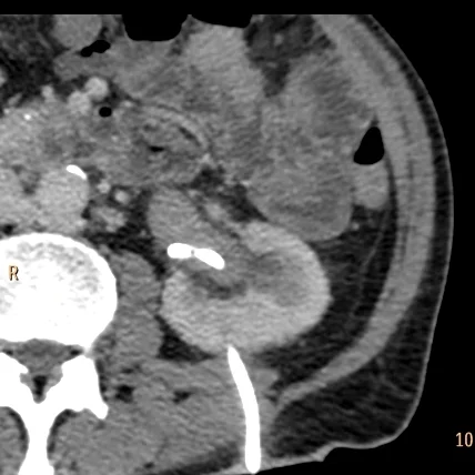 Conventional CT: Is that a mass in the left renal pelvis? Note the nephrostomy tube.
