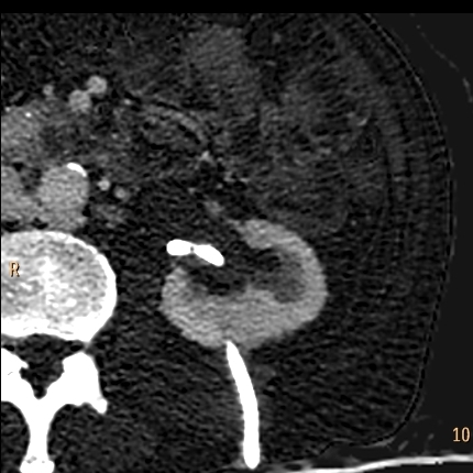 No iodine uptake, so this is clot.