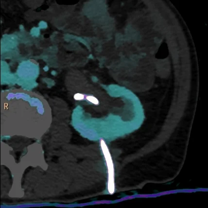 Renal pelvis: urothelial cancer or not?