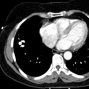 Pulmonary AVM seen on axial image
