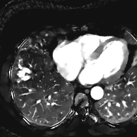 Iodine map shows perfusion deficit seen around the AVM