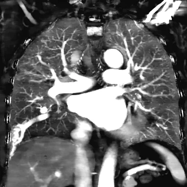 Iodine map in the coronal plane nicely illustrates the pulmonary AVM and adjacent perfusion defect. This is because of blood (and iodine) shunting into the low pressure system, and results clinically in hypoxemia, that then sets off compensatory mechanisms resulting in polycythemia.