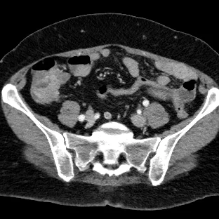 Conventional CT: Can you see the subtle lesion in the cecum?