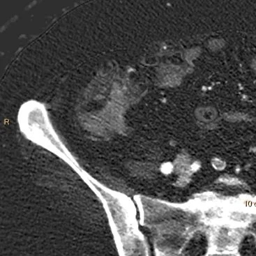 Iodine map: Uptake confirms this is no stool-ball..
