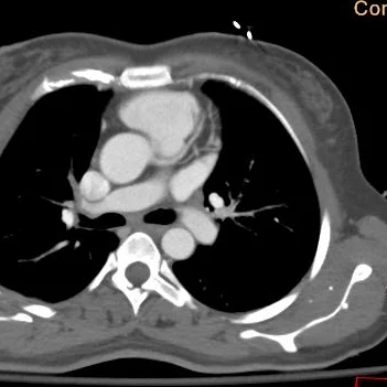 There is a PE in the left lower lobe lateral segment, but no matter how good a day you are having, you are not going to see it