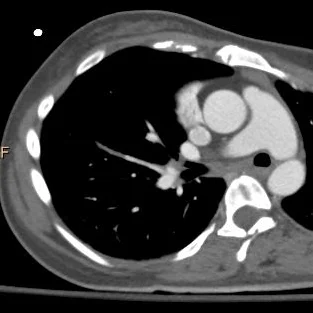 Another tiny PE in the right lower lobe on an oblique axial image...