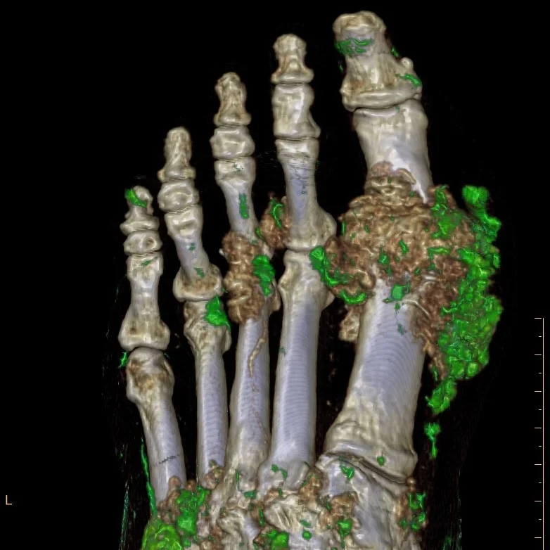 Of course, we can do gout