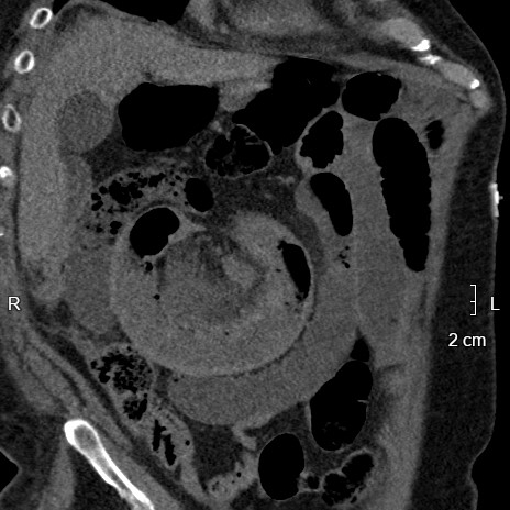 Conventional CT, oblique coronal plane: Closed loop in right abdomen (note the radial arrangement)