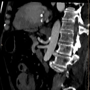Sagittal MIP image (50 keV) shows patent celiac artery and SMA