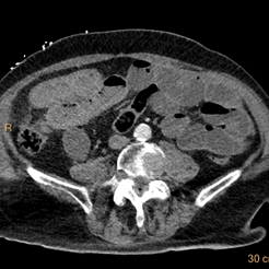 Conventional axial image with closed loop in right lower quadrant