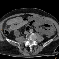 Virtual non-contrast: wall of closed loop remains hyperdense consistent with hemorrhage