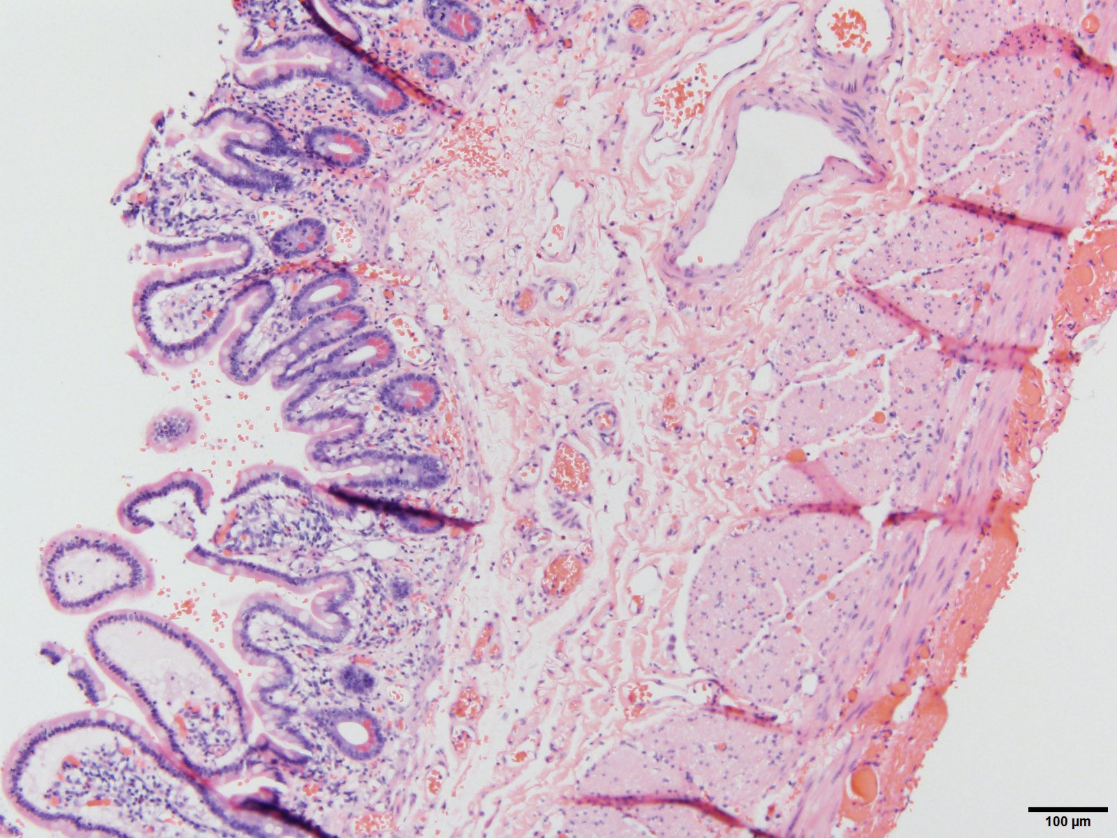 Histopath (courtesy of Dr. Cameron, HCMC): Viable bowel at the margin. Note the healthy mucosa, and a small amount of serosal hemorrhage