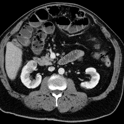 Conventional CT: Subtle right kidney lesion. Note dilated loops of small bowel.