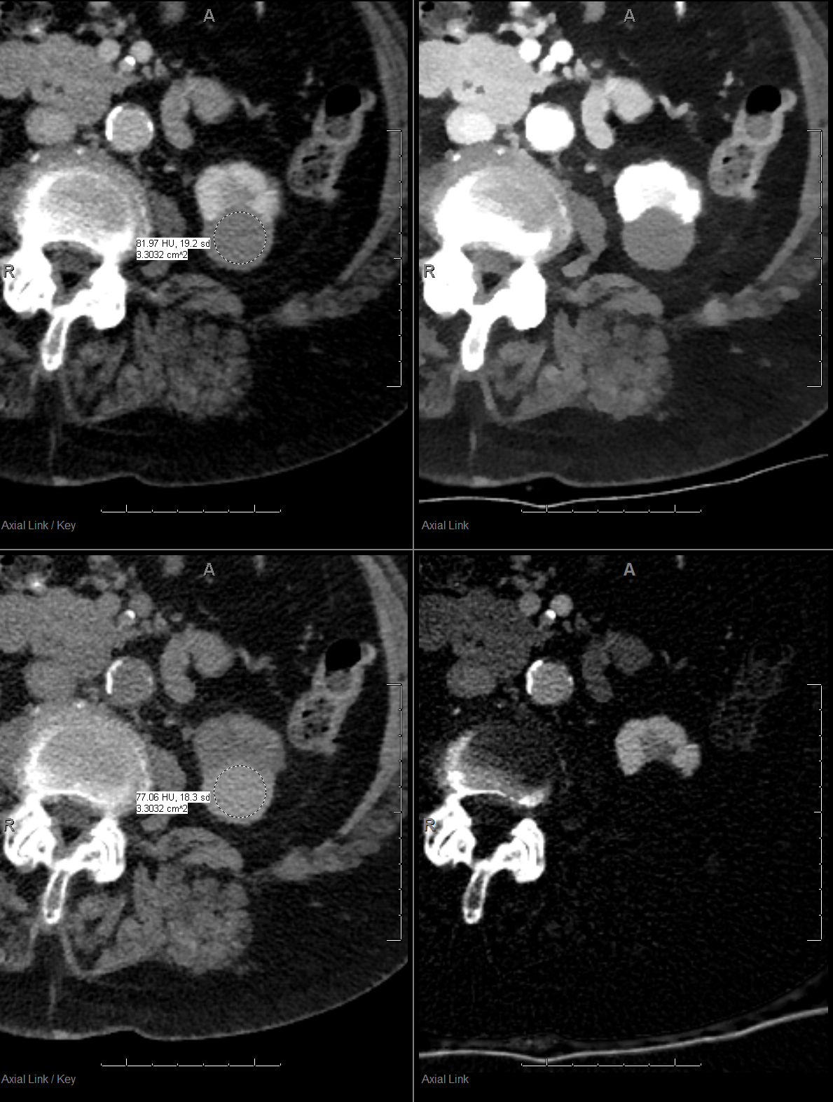 Another PACS screenshot (different patient, clockwise from top left): Conventional CT with 82 HU indeterminate left kidney lesion, 40 keV mono-E image, iodine map with no iodine uptake at all, and virtual non-contrast with attenuation of 77 HU. This is a hemorrhagic cyst! You just saved the system an MR scan, and more importantly, saved this human being the anxiety and pain of an additional exam.