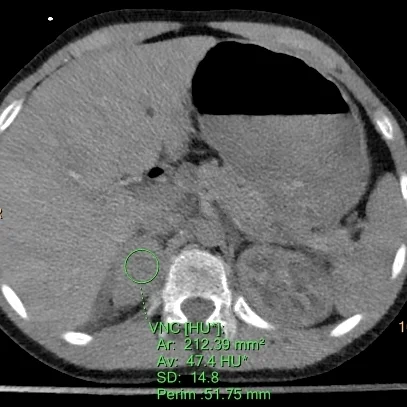 Virtual non-contrast: Attenuation in the adrenal nodule remains the same