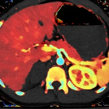 An adrenal nodule