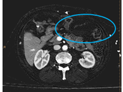Iodine map: A second loop in left upper quadrant without perfusion