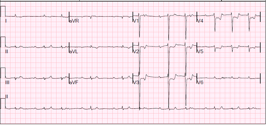First EKG: Note extensive ST depressions (most marked in V2-V6)