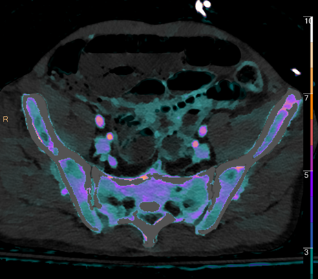 Transient bowel ischemia