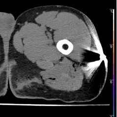 Virtual non-contrast: the hyperdensity is not visualized.