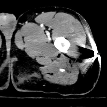 40 keV monoE significantly accentuates the active extravasation.