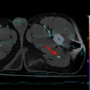 Million dollar wound