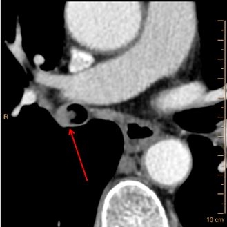 Case 1: Conventional CT with thickening of bronchus intermedius and a filling defect (red arrow).