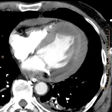 Conventional trauma CT: Note hemopericardium and filling defect in the LV apex.