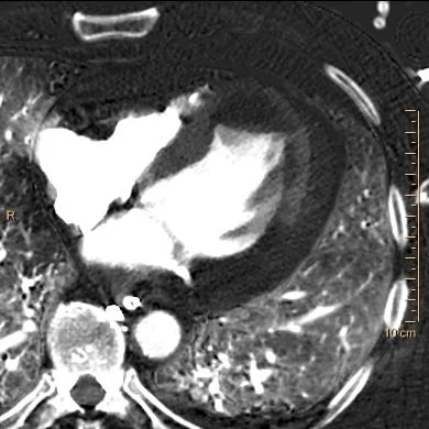 Iodine map: LV apical clot without iodine uptake. Can you appreciate the hypoperfusion in the inferolateral wall? If not, delayed images below make it much more obvious.
